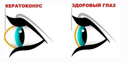 Людмила Лазарева Убираем кератоконус. Возвращаем нормальную форму глаз 