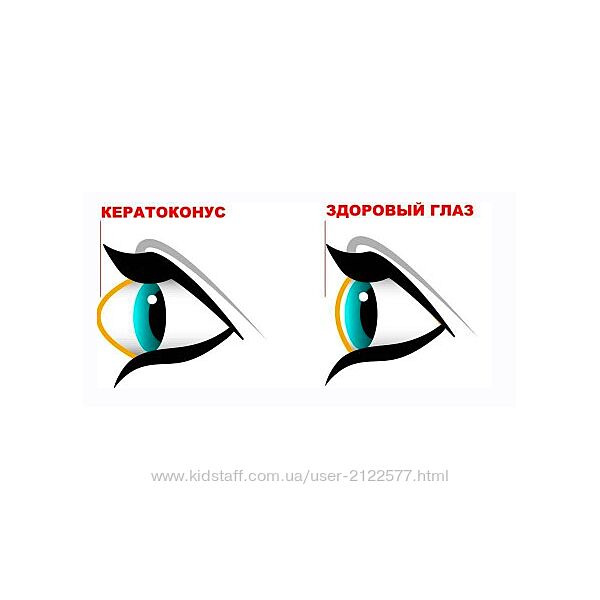Людмила Лазарева Убираем кератоконус. Возвращаем нормальную форму глаз